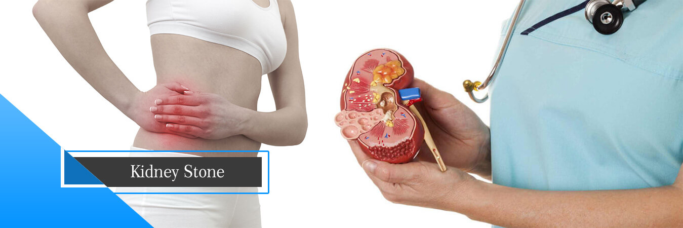 Differences between PCNL and Other Kidney Stone Removal Techniques