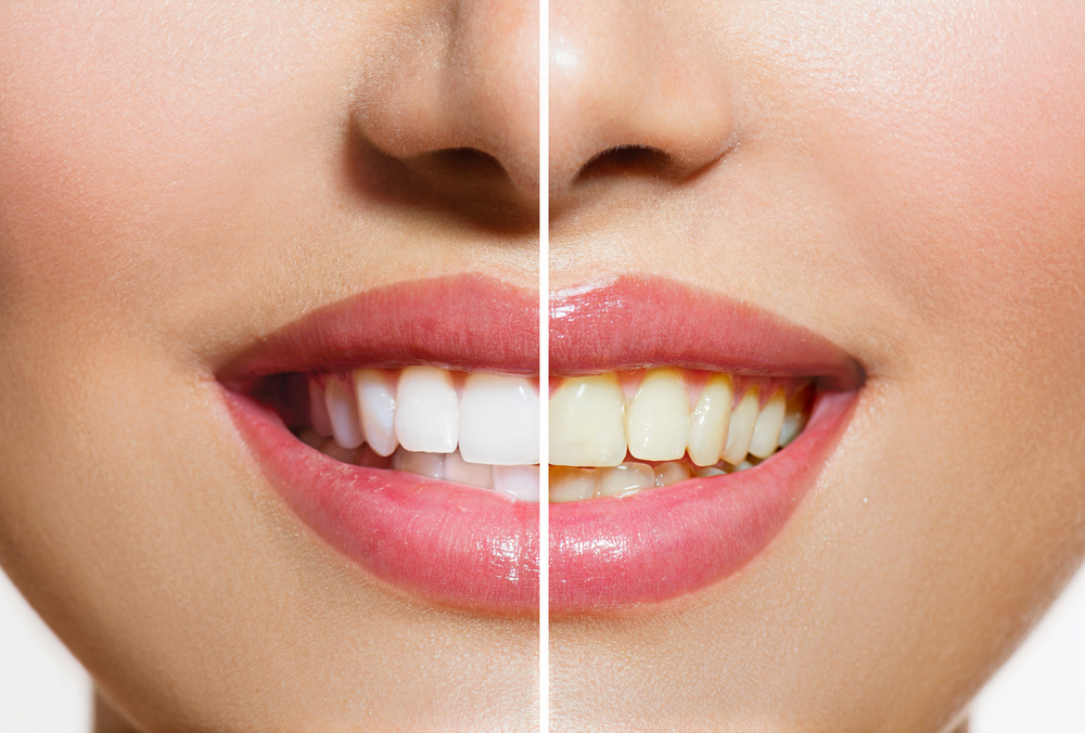 What are the causes of yellow teeth, and how do you avoid them? 